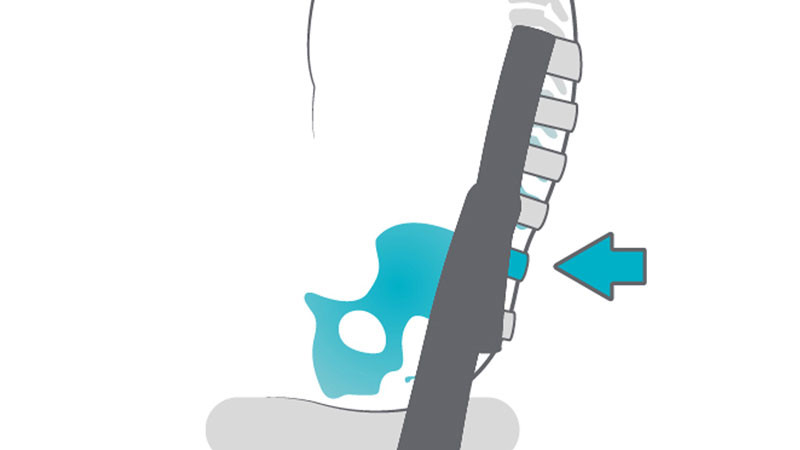 Card item - Pelic support - Tilted pelvis