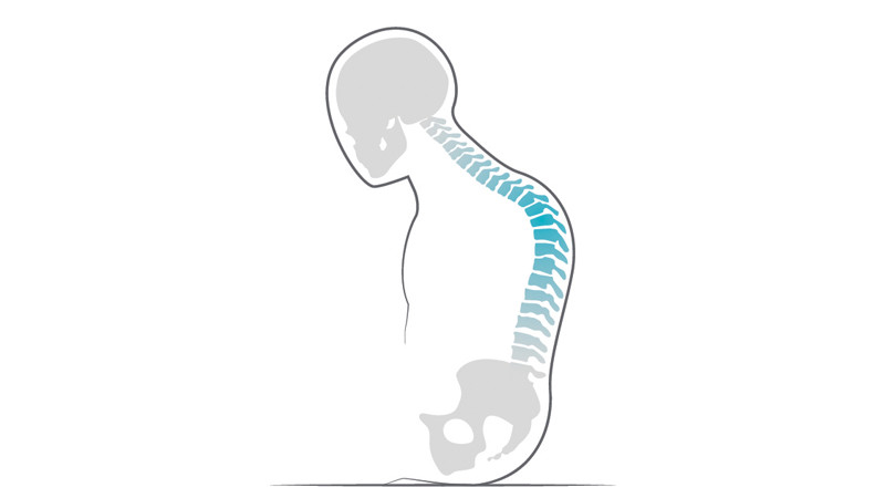 Card item block - Body shape Kyphosis Prio 3A
